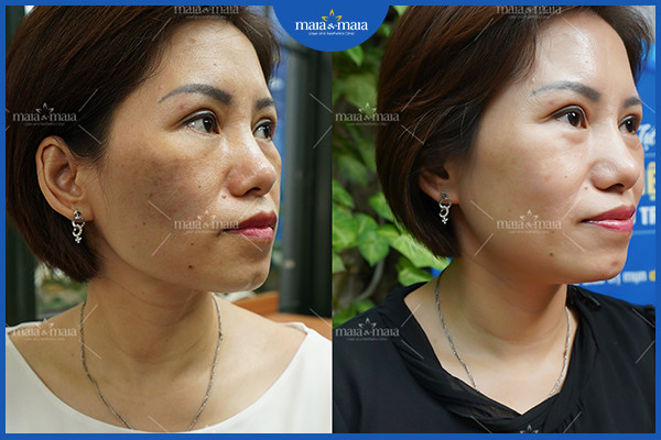 Hiệu quả điều trị nám đa trị liệu tại phòng khám Maia