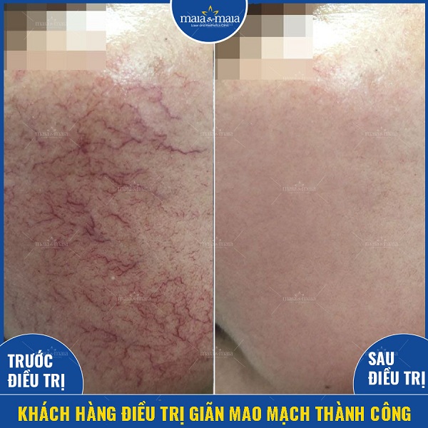 Hỗ trợ điều trị giãn mao mạch