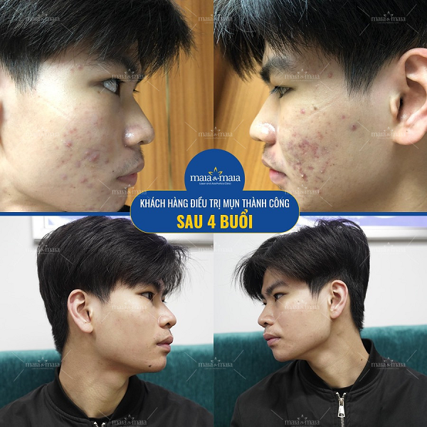 Hỗ trợ điều trị mụn trứng cá và thâm mụn