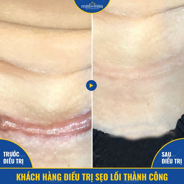 Hỗ trợ điều trị sẹo lồi