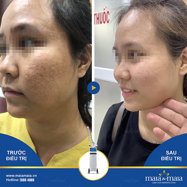 Hỗ trợ điều trị sẹo lõm