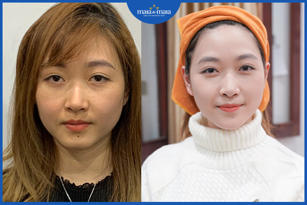 Làn da được cải thiện nhờ công nghệ trẻ hóa da tiên tiến