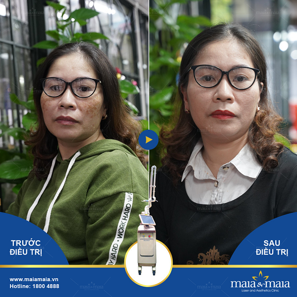 Hỗ trợ điều trị nám da
