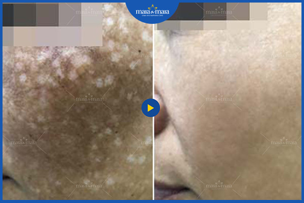 Hiệu quả của sử dụng laser trong điều trị sắc tố