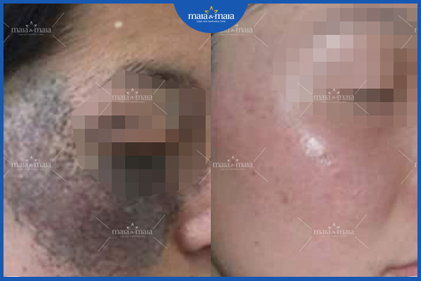 Hỗ trợ điều trị bớt sắc tố