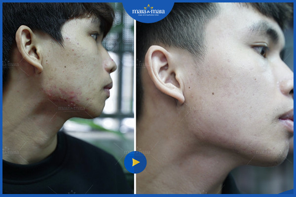 Hiệu quả điều tị mụn tại phòng khám