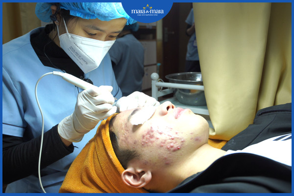 Loại bỏ nhân mụn bằng công nghệ cao tại phòng khám Maia
