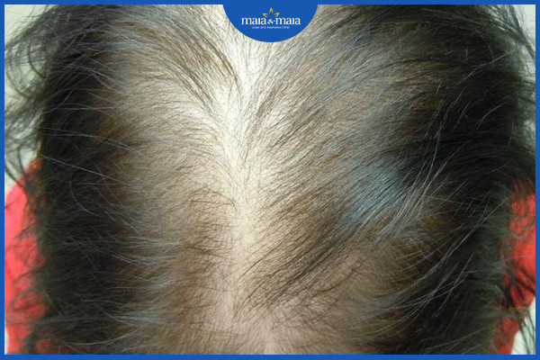 Tóc bị rụng và thưa theo kiểu telogen