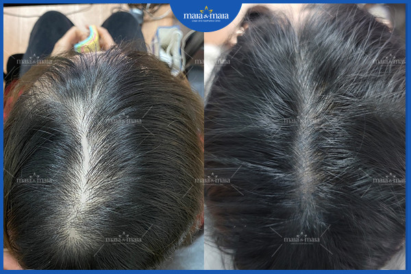 Hiệu quả sau điều trị rụng tóc tại phòng khám Maia