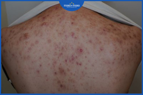 Mụn viêm và thâm rất nhiều trên lưng một khách hàng
