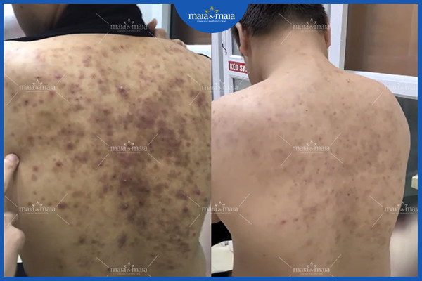 Cần ngăn ngừa mụn lưng để không gặp những biến chứng do mụn