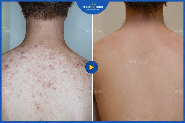 Loại bỏ mụn lưng để có làn da thẩm mỹ và khỏe mạnh hơn