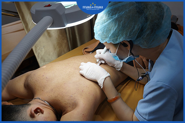 Loại bỏ nhân mụn bằng công nghệ laser Diot tại phòng khám Maia