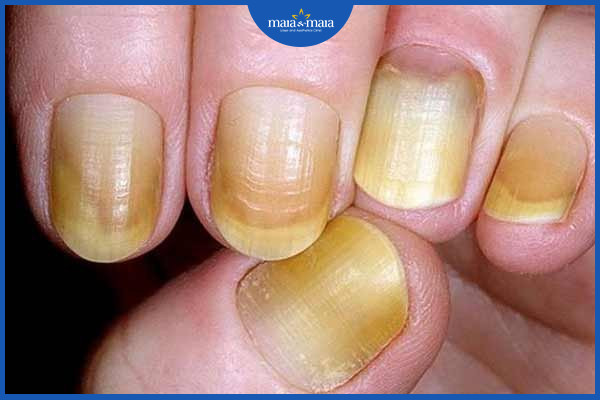Rối loạn móng do ảnh hưởng của việc hút thuốc lá