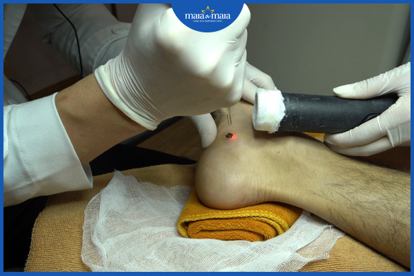 Điều trị mụn cóc bằng laser tại phòng khám maia