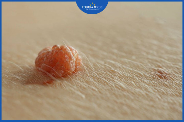 Mụn cóc dạng sợi