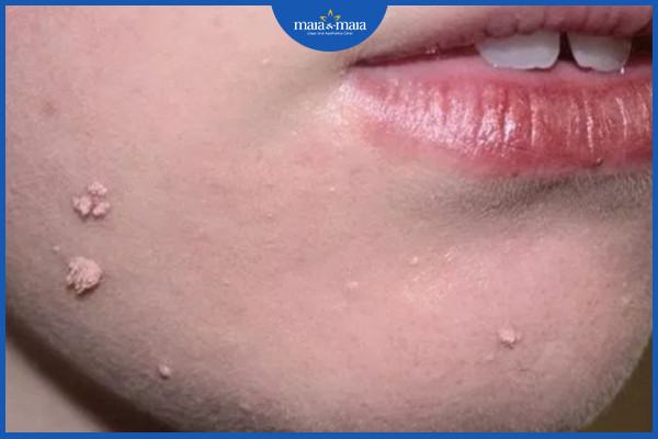 Mụn cóc dạng sợi ở vùng mặt