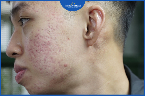 Sẹo lõm do mụn trứng cá