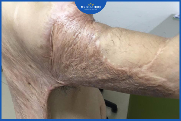 Sẹo co kéo làm ảnh hưởng tới chất lượng cuộc sống