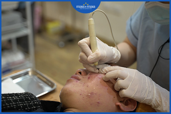 Điều trị mụn sớm để ngăn ngừa sẹo