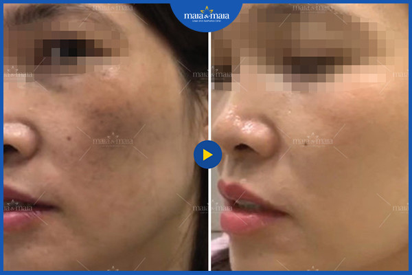 Hiệu quả cải thiện nám da, làm đều màu da tại phòng khám Maia
