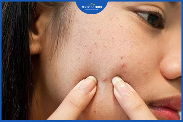 Không nên nặn mụn bằng tay, tránh việc mụn tiến triển nặng hơn