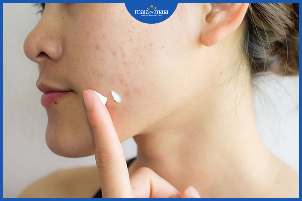 Tự ý bôi thuốc trị mụn là một trong những cách trị mụn sai lầm