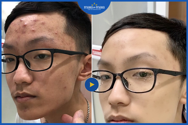Hiệu quả điều trị mụn chuẩn y khoa tại phòng khám Maia