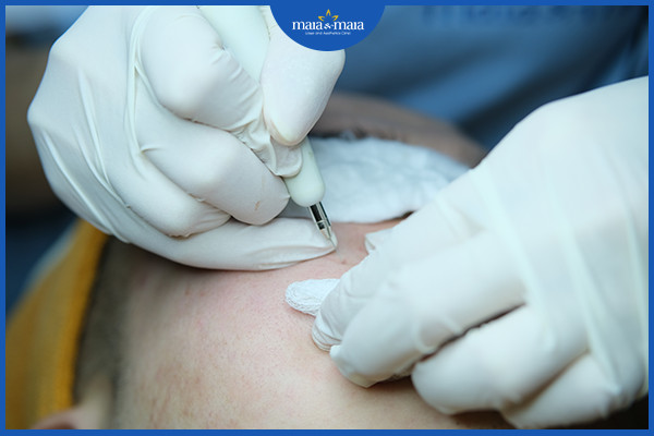 Loại bỏ nhân mụn bằng Laser diot tại phòng khám Maia