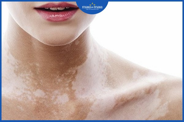 bạch biến có lây không