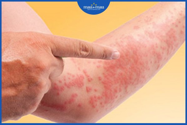 dấu hiệu dị ứng bia