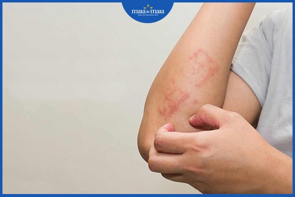 dị ứng có di truyền không