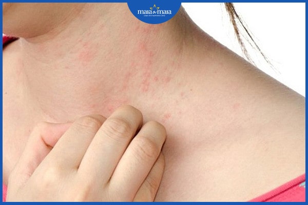dị ứng thực phẩm và cách điều trị