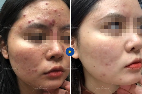 Ngăn ngừa mụn tái phát bằng cách điều trị với bác sĩ da liễu