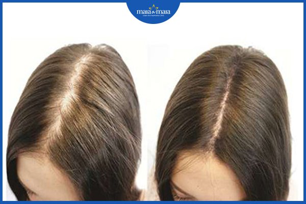 trị rụng tóc
