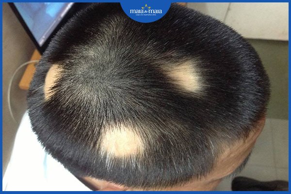 rụng tóc bất thường