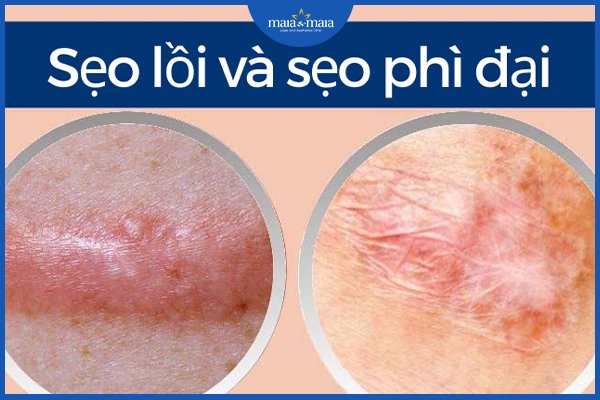 sẹo lồi và sẹo phì đại