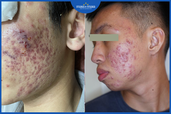 Tình trạng sẹo thâm sau mụn