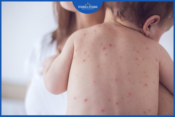 thủy đậu dễ lây nhất khi nào