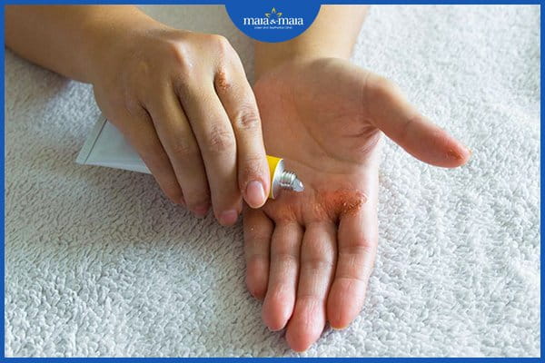 bệnh vảy nến phấn hồng