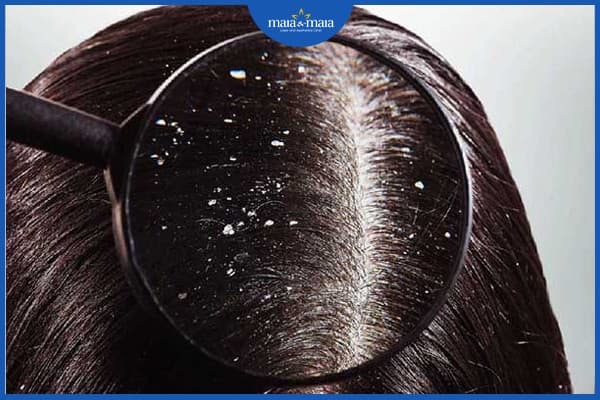 chân tóc yếu dễ rụng
