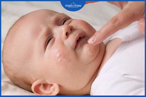 dị ứng thời tiết bao lâu thì khỏi