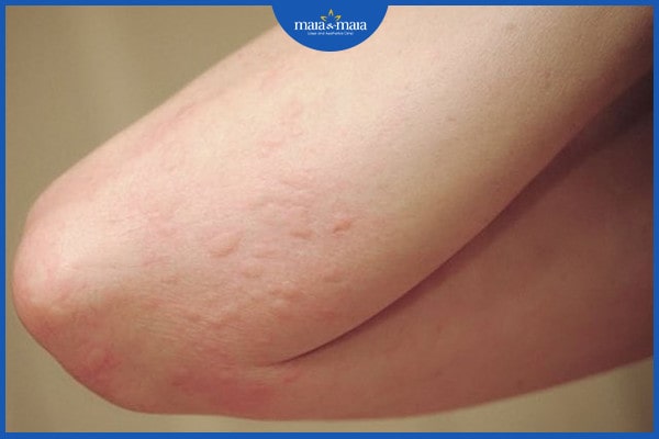 dị ứng thời tiết có nguy hiểm không