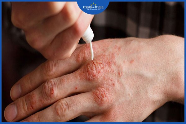 điều trị bệnh vảy nến
