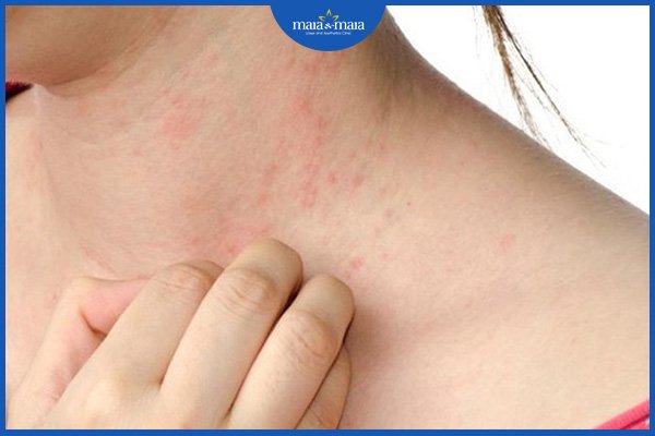 viêm da dị ứng bao lâu thì khỏi