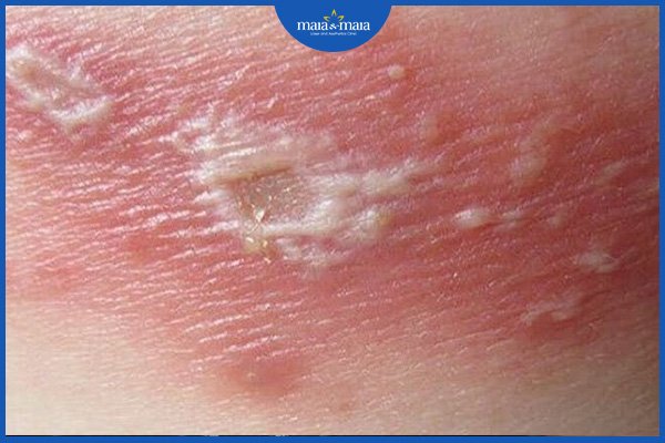viêm da dị ứng bội nhiễm