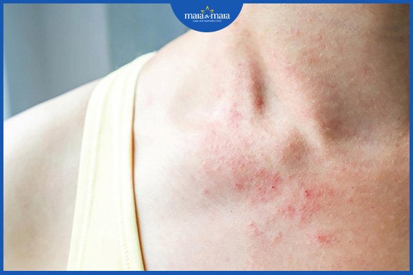 viêm da dị ứng có lây không