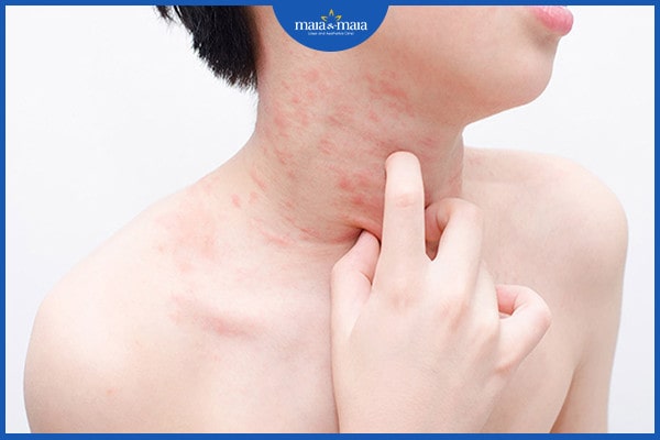 viêm da dị ứng