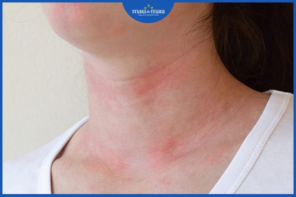 viêm da dị ứng ở cổ