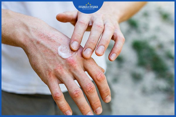 viêm da dị ứng ở tay chân